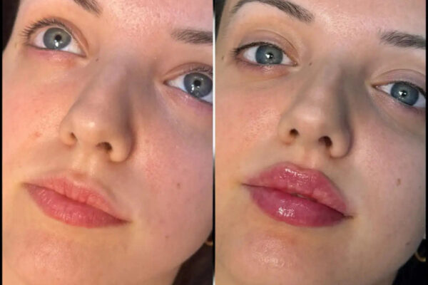 Fillers Treatment in Dubai for Restoring a Youthful Appearance with Fillers fillers in dubai