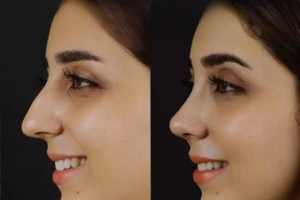 The Future of Nose Deviated Septum Surgery in Dubai Septoplasty in Dubai