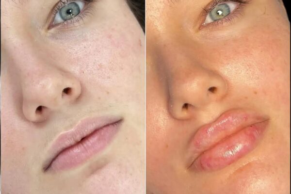 Fillers in Dubai