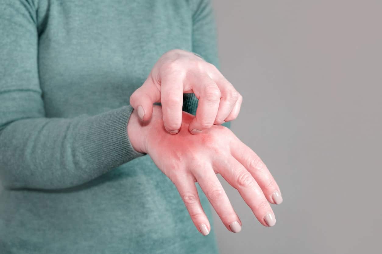 How Scabies Spreads and How to Protect Your Family