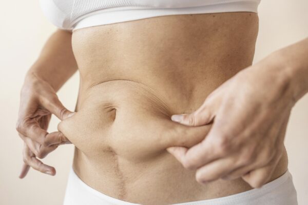 Liposuction Surgery with Best Liposuction Surgeon in Dubai Liposuction in Dubai
