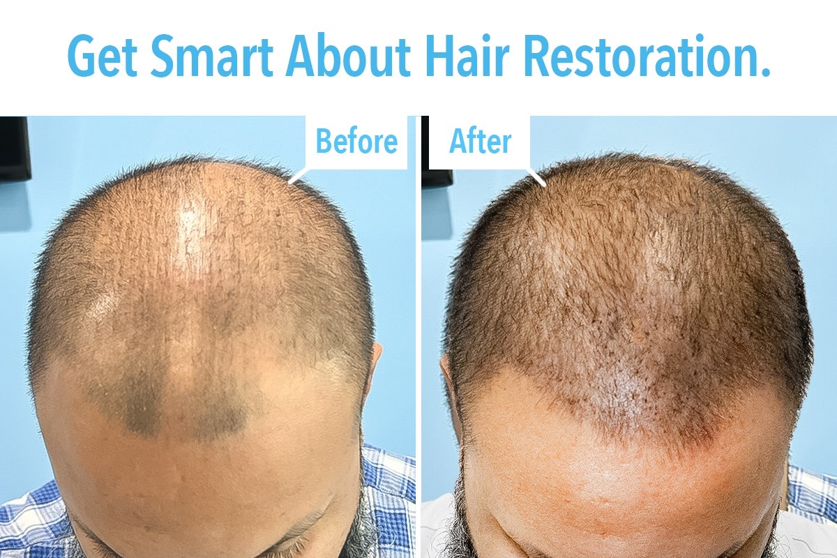 WhatIsSmartGraftHairRestoration