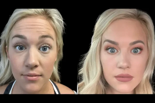 How the Best Doctors in dubai Deliver Natural, Youthful Botox Results