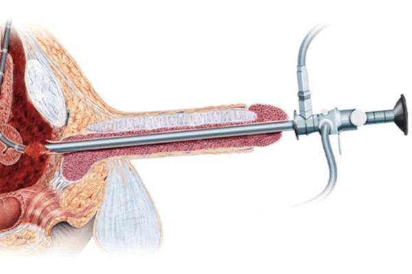 Urethral Stricture: Causes, Symptoms & Treatment Urethral Stricture