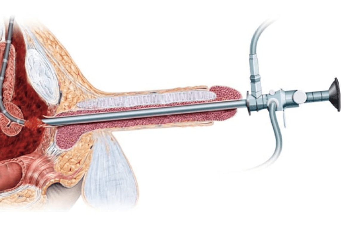 Urethral Stricture