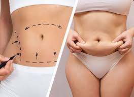 Abdominoplasty in Islamabad – Transform Your Midsection with Confidence
