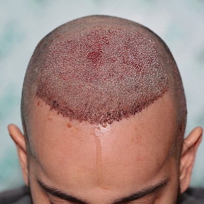 hair transplant in islamabad