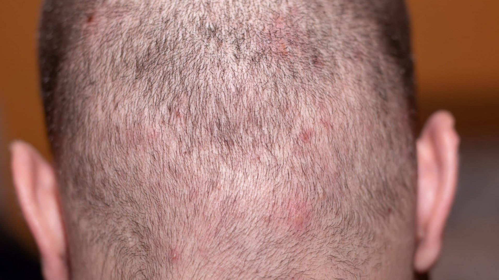 pimple-like bumps