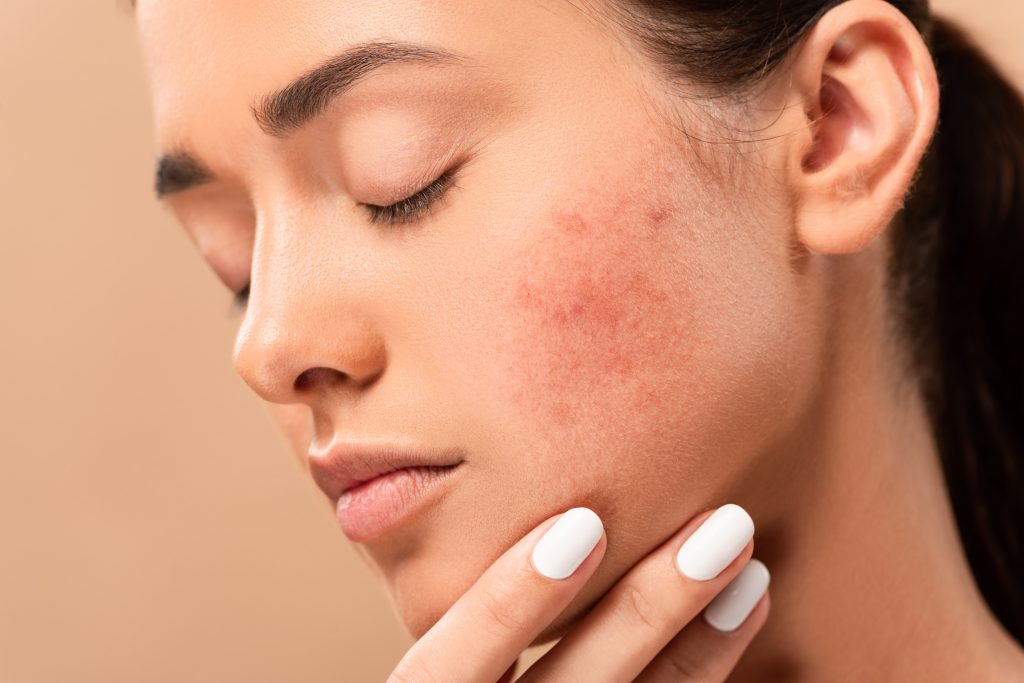 Acne Scar Treatment - Adore Skin Clinic