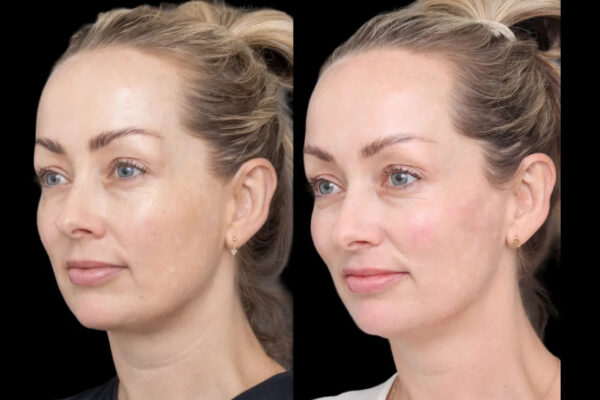 Cheek Fillers in Dubai