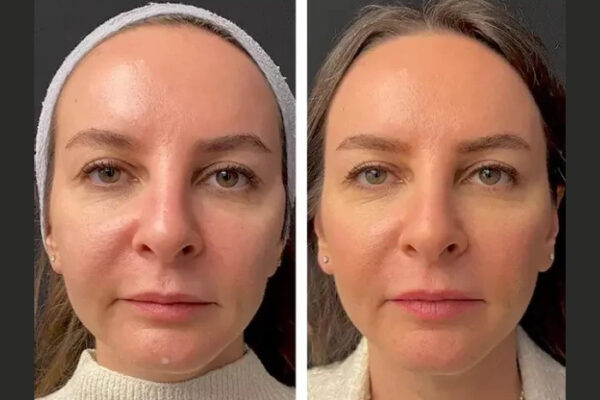 Booking Your First Mesotherapy Appointment at the Best Aesthetic Clinics in Dubai