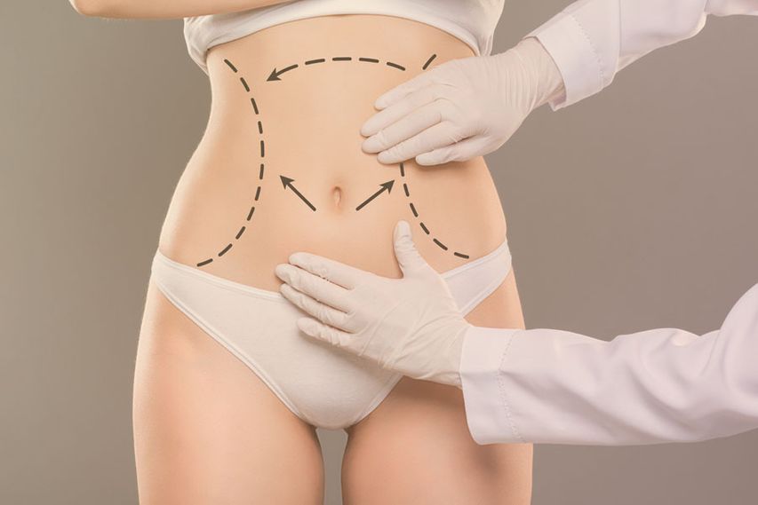tummy tuck in Dubai