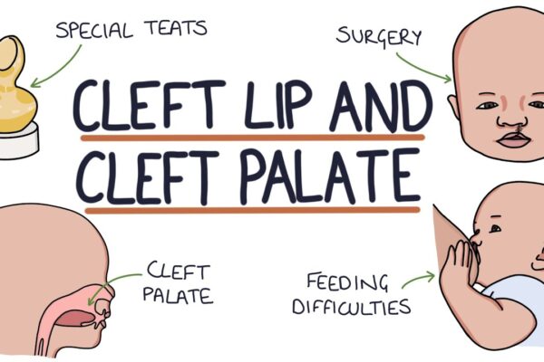 Everything You Need to Know About Cleft Lip and Palate Surgery Costs in India