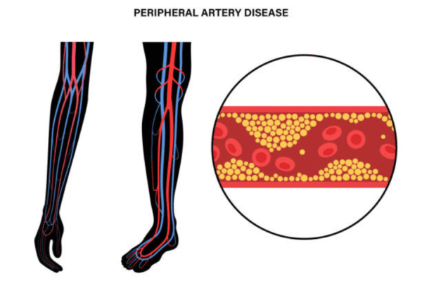 Understanding Peripheral Arterial Disease in Simple Terms