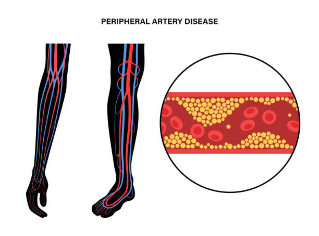Understanding Peripheral Arterial Disease in Simple Terms
