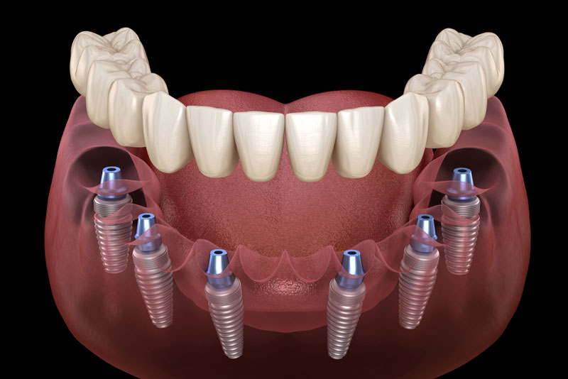 root canal in Burlington